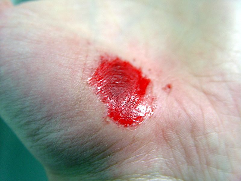 embedded wound