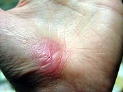 180px-Hand Abrasion - 30 days 4 hours 43 minutes after injury.jpg