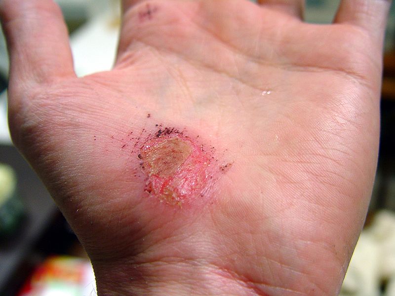 800px-Hand Abrasion - 2 days 22 hours 12 minutes after injury.jpg
