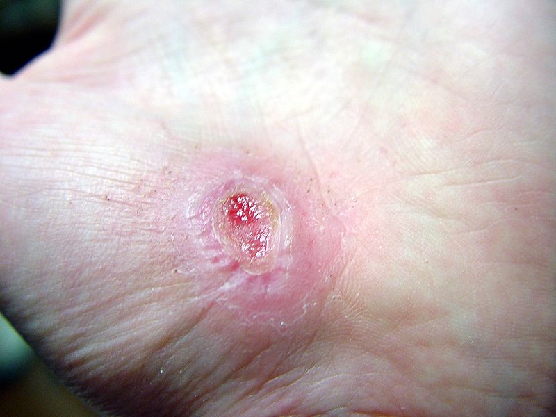 800px-Hand Abrasion - 17 days 11 hours 30 minutes after injury.jpg